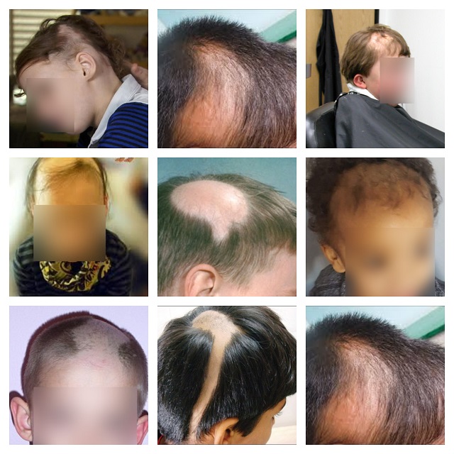 Why So Many Are Loving Dr Hair Usa Dr Hair Usa